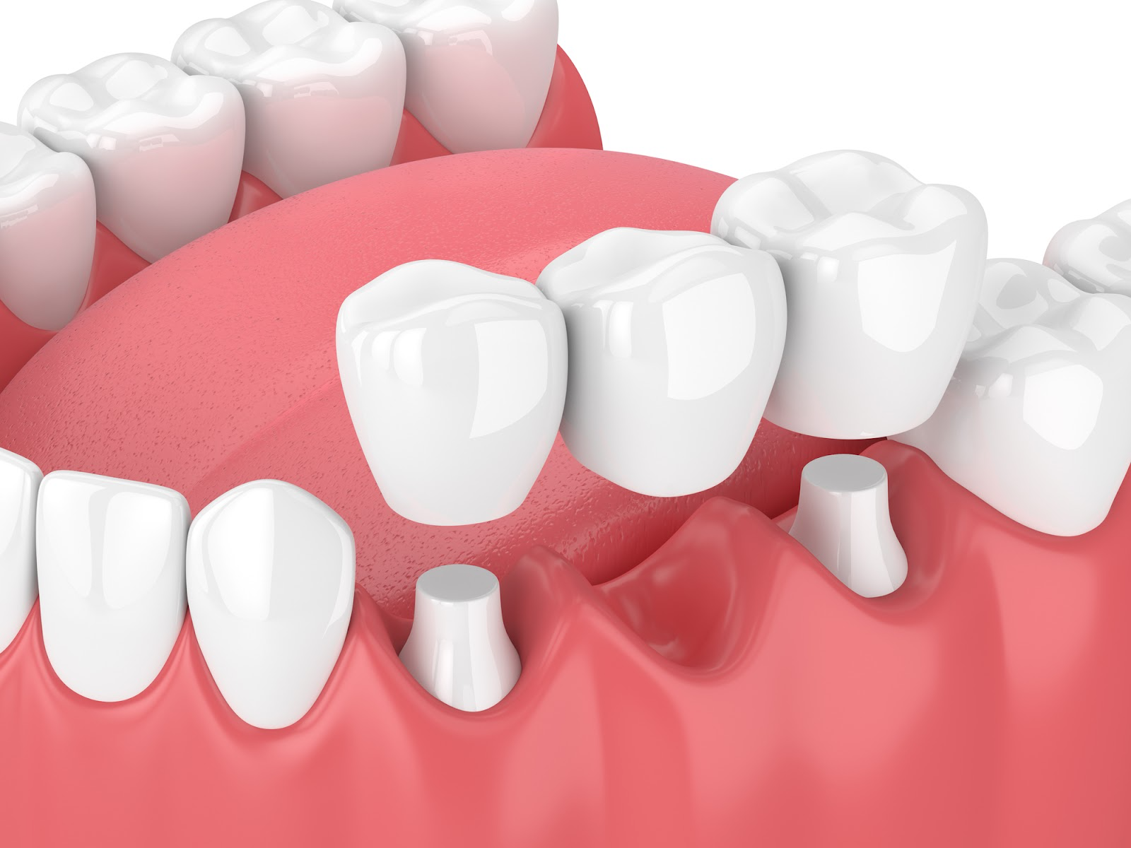 “How much is a dental bridge?” and other FAQs