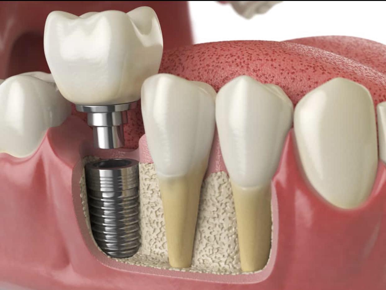 Dental Implant Questions?